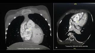 Role of TEE and Epicardial Echo to Assess Surgical Repair in Double Outlet Let Ventricle [upl. by Aiekram]