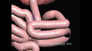 Intussusception of the Bowel video  Animation by Cal Shipley MD [upl. by Gonsalve97]