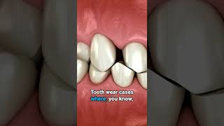 What is an Occlusal Splint [upl. by Anileda185]