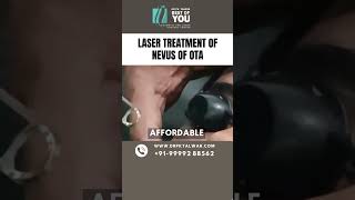 Treatment of Nevus of OTA Removal Procedure Laser Treatment of Nevus of OTA in Delhi Dr PK Talwar [upl. by Charlot616]