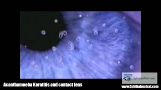 Acanthamoeba Keratitis and contact lens [upl. by Isidora]