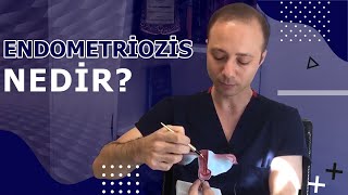 Endometriozis “Çikolata Kisti” Nedir  Doç Dr İlker Kahramanoğlu [upl. by Vinay]