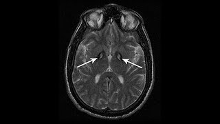 319 Neurodegeneration with Brain Iron Accumulation  Dystonias Spring Video Atlas [upl. by Craven]