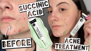 BEST NEW ACNE TREATMENT  TESTING THE INKEY LIST SUCCINIC ACID ON MY ACNE FOR 2 WEEKS [upl. by Ratib]