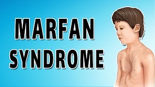 Marfan Syndrome [upl. by Akinad]