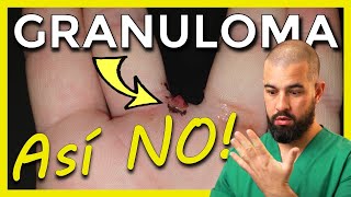 GRANULOMA PIOGENO Cómo quitarlo VÍDEO REAL explicado BOTRIOMICOMA [upl. by Olegnalehcim784]