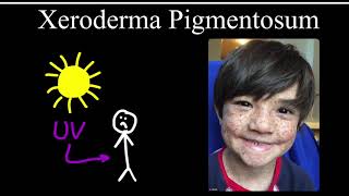 Xeroderma Pigmentosum [upl. by Benji]