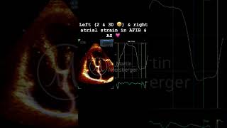 Left amp right atrial Strain in aortic stenosis  elevated filling pressures right🫀 [upl. by Chantal]