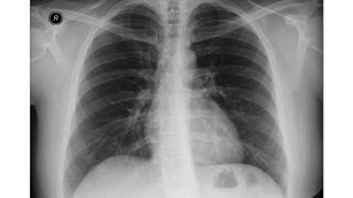 chest xray  Idiopathic Pulmonary Fibrosis [upl. by Imer326]