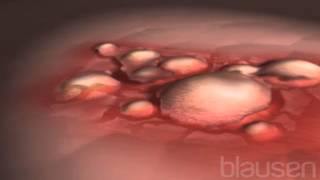 Eczema Animation [upl. by Hermann]