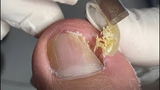 Deep nail cleaning [upl. by Akihsat]