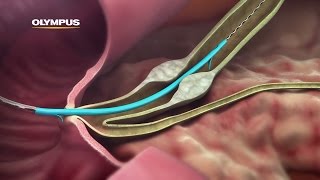 QuickPlaceV Biliary Stent [upl. by Aineg]