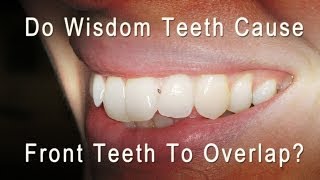 Do Wisdom Teeth Cause Front Teeth To Overlap and Get Crowded [upl. by Leryt]