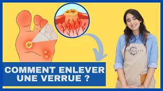 Comment enlever les verrues naturellement   HPV Causes symptômes prévention et solutions [upl. by Harrod]