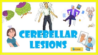 Cerebellar lesionsexamination signs lesions and ataxic gait heel knee shin test [upl. by Chilt]