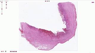 Chronic Cholecystitis with Acute Exacerbation  Histopathology [upl. by Bain633]