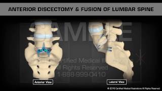 Anterior Discectomy amp Fusion of Lumbar Spine [upl. by Egedan]