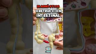 ¿intestino irritable u obstrucción intestinal  doctor jovel cirujano [upl. by Efinnej]