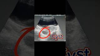 Bulky Uterus  Retroverted Uterus  Ovary Cyst  Simple Cyst on Ultrasound [upl. by Ramey]