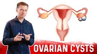 Ovarian Cysts Causes Symptoms amp Natural Treatment – DrBerg [upl. by Grondin]