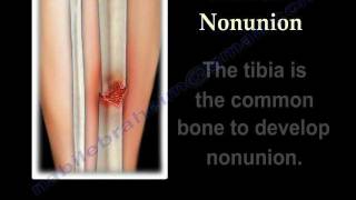 NONUNION OF FRACTURES CAUSES AND TREATMENT  Everything You Need To Know  Dr Nabil Ebraheim [upl. by Miriam]