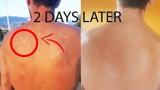 How I cured Tinea Versicolor in 2 days forever [upl. by Tara33]