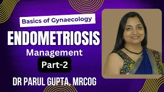 Endometriosis Part  2  Management [upl. by Pernell696]