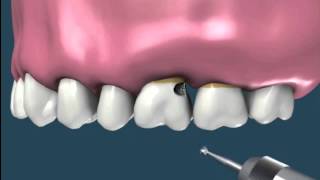 Alargamiento coronario para reconstrucción  Odontología Restauradora [upl. by Creedon]