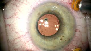 IZHV Iridozonular hyloid vitrectomy and Floaterectomy by Steven G Safran MD [upl. by Neelac]