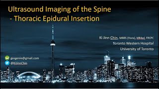 Ultrasound Imaging for Thoracic Epidural Insertion [upl. by Imeaj251]