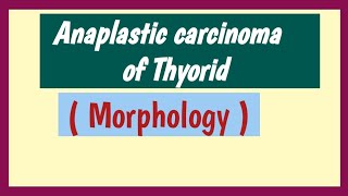 Anaplastic Carcinoma Of Thyroid Morphology [upl. by Lundt]