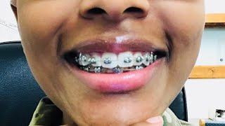 I GOT MY BRACES  VLOG 3  3 Month Update [upl. by Gies365]