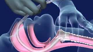 Nasal Intubation [upl. by Fenn]