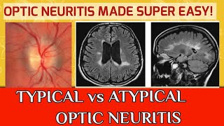 OPTIC NEURITIS  Typical optic neuritis and atypical optic neuritis [upl. by Enigroeg]