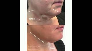 Radiesse For Jawline Contouring By Dr Stephen Bracci [upl. by Asabi]