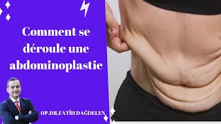 Comment se déroule une abdominoplastie [upl. by Rucker]