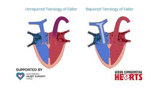 Tetralogy of Fallot Repair [upl. by Lairret]