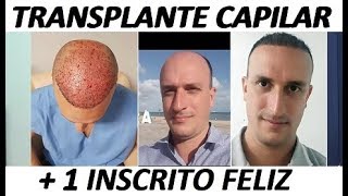 Transplante CAPILAR 5 meses ANTES e DEPOIS  Implante capilar resolve Vale a pena fazer [upl. by Girand]