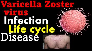 Varicella zoster virus pathogenesis  chickenpox virus [upl. by Jemina167]