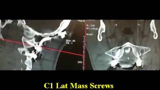 Occipitocervical Fusion for C1C2 Dislocation and Odontoid Fx [upl. by Higginbotham495]