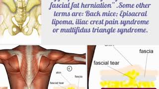 Have lower back pain with soft lumps that move They are not trigger points They may be “lumbar f… [upl. by Stafani]