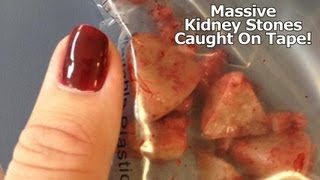 Massive Kidney Stones Caught On Tape Must See [upl. by Ahsitel]