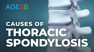 What Causes Thoracic Spondylosis  MidBack Or Thoracic Pain  Thoracic Spine Pain [upl. by Aizahs]