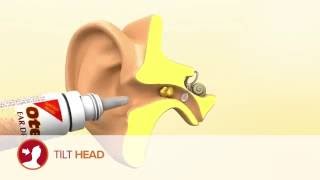 How to use Otex Ear Drops [upl. by Rafaelia558]