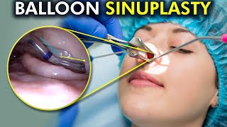 Balloon Sinuplasty Unveiled A Painless Path to Clear Sinuses 3d Animation [upl. by Irrac]