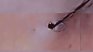 Removal of ingrown hair [upl. by Grace]