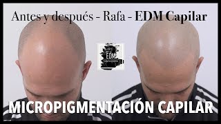 Antes y después en Micropigmentación capilar  Testimonio real del caso de Jose [upl. by Rosinski]