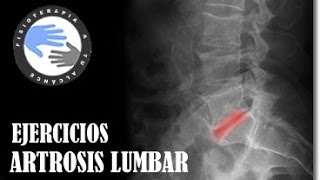 Artrosis de columna lumbar ejercicios [upl. by Deeraf]