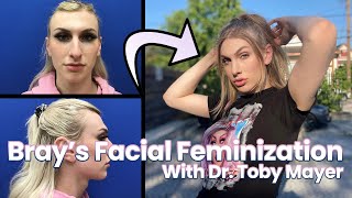 Brays Facial Feminization Story With Dr Toby Mayer [upl. by Riamo]