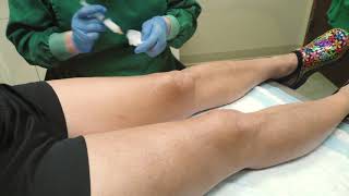 Hyperdilute Radiesse® Tightening the Skin Above the Knees and Arms [upl. by Krucik]